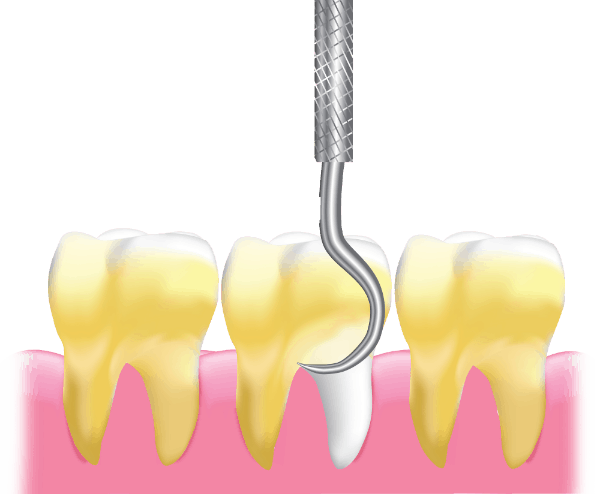 Advanced OPG Scan - Detect Dental Issues Efficiently